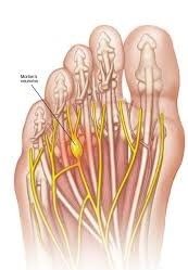 نورومای مورتون (درد و گزگز سینه پا و بین انگشتان پا): علت و درمان آن