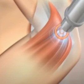 Shockwave therapy treatment