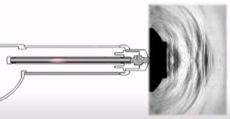 what is shock wave therapy