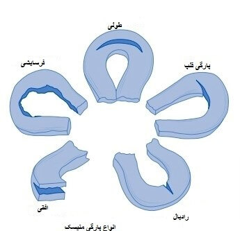 انواع پارگی منیسک