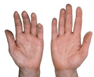 تحلیل رفتن قاعده شست (برجستگی تنار)