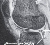 تشخیص پارگی منیسک های زانو