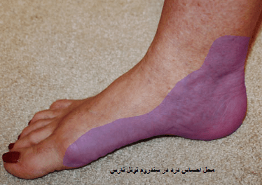 درمان گرفتگی عصب مچ پا