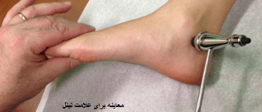 درگیری عصب مچ پا