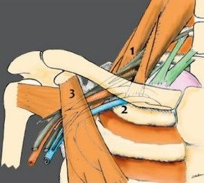 سندروم خروجی توراکس