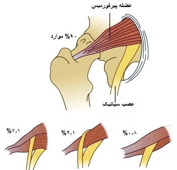سندروم پیریفورمیس چیست