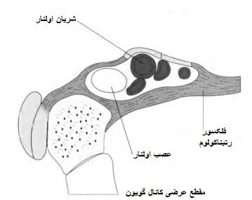 سندروم کانال گویون
