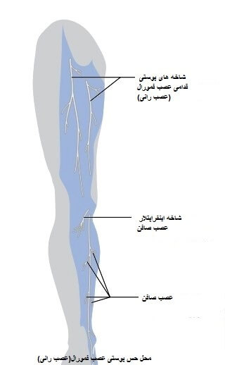 شایع ترین علت آسیب عصب فمورال یا عصب رانی