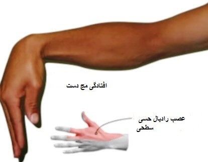 عصب رادیال حسی سطحی