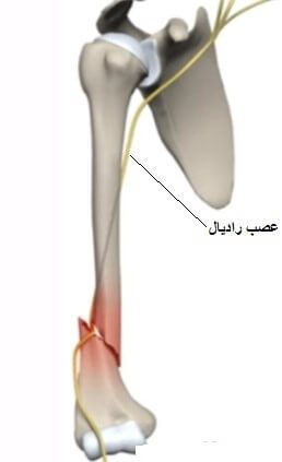 عصب رادیال در ناحیه بازو