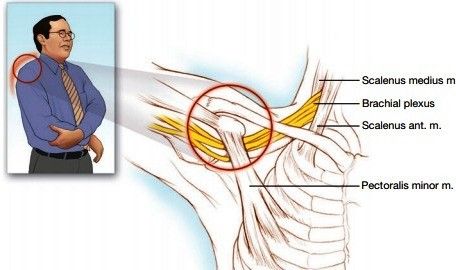 علائم ونشانه های سندروم خروجی قفسه توراکس