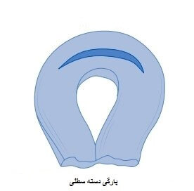 پارگی دسته سطلی منیسک