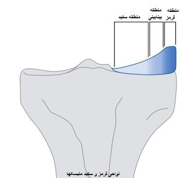 پارگی های منسیک